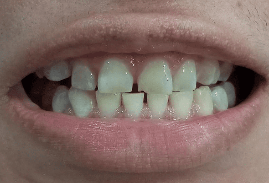 especialistas carillas dentales monterrey