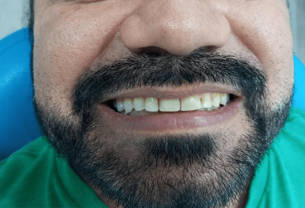 clinica carillas dentales monterrey