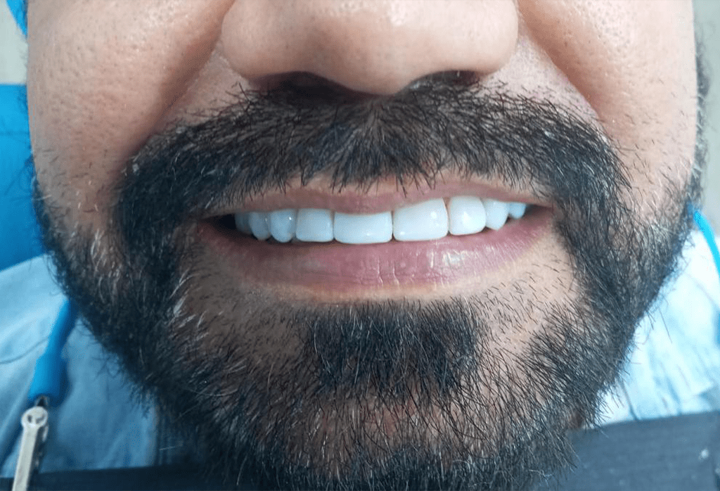 dentistas carillas dentales monterrey